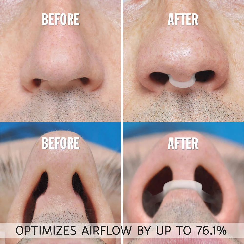 Clip Nasal de Silicone Antirronco — Dilatador Nasal para Respirar Melhor e Dormir Bem