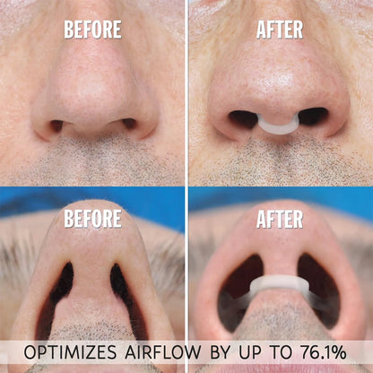 Clip Nasal de Silicone Antirronco — Dilatador Nasal para Respirar Melhor e Dormir Bem
